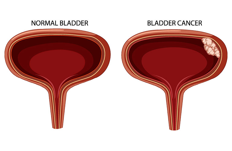 bladder cancer -01