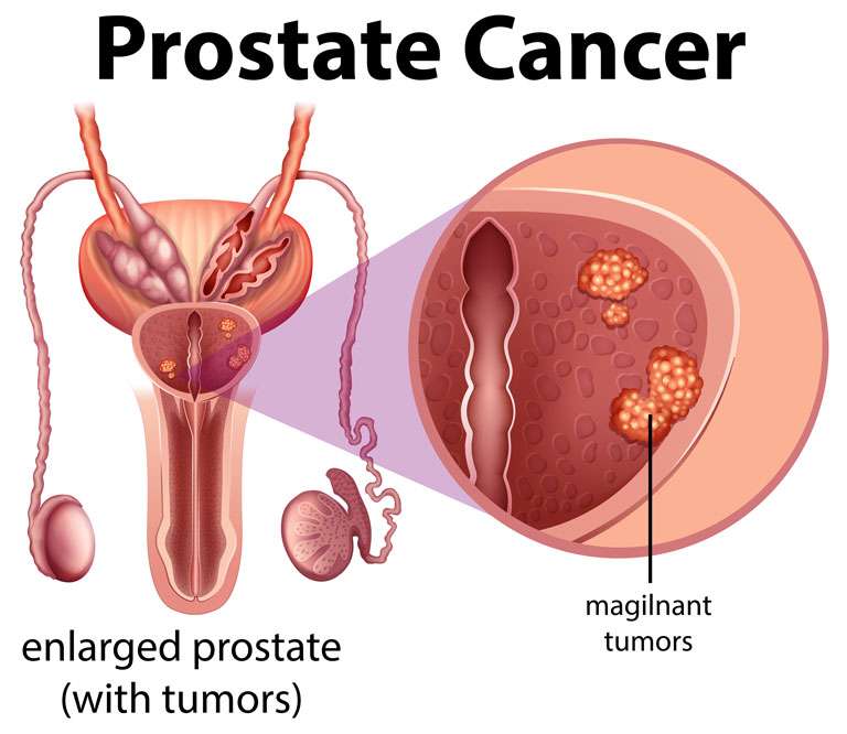 carcinoma prostate