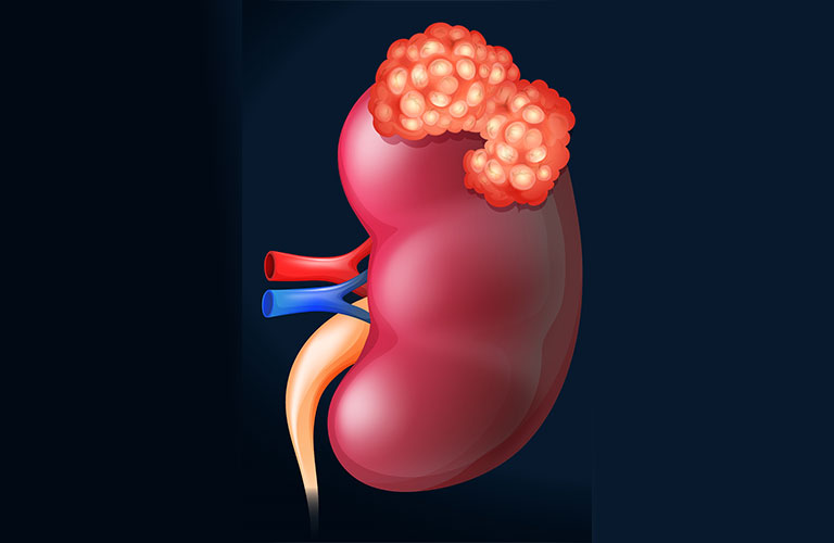 Best Cancer Hospital For Kidney Cancer Treatment In Vadodara Best Cancer Hospital For Kidney Cancer Treatment In Vadodara