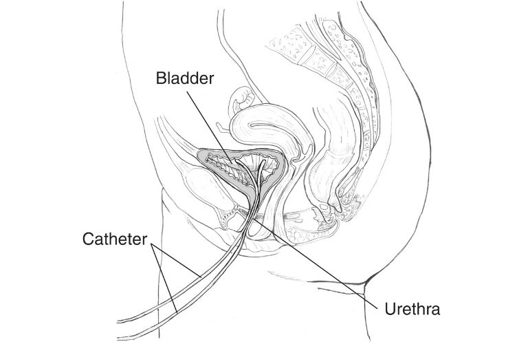 Suprapubic Catheter