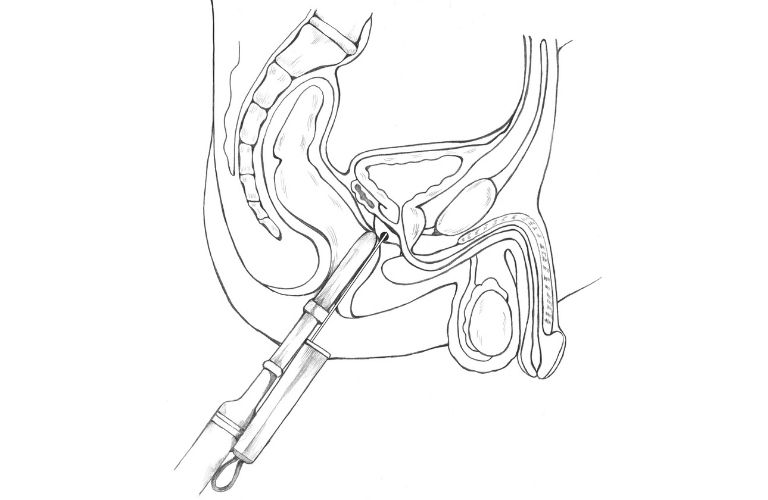 Transurethral Resection Of The Prostate (T.U.R.P.)
