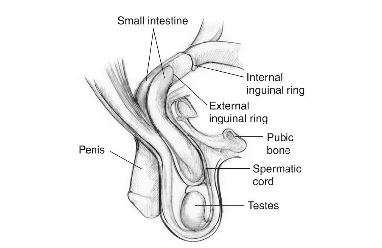 Testicular Cancer overview