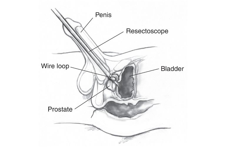 Transurethral-Incision-of-The-Prostate