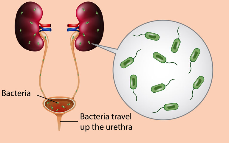 uti infection