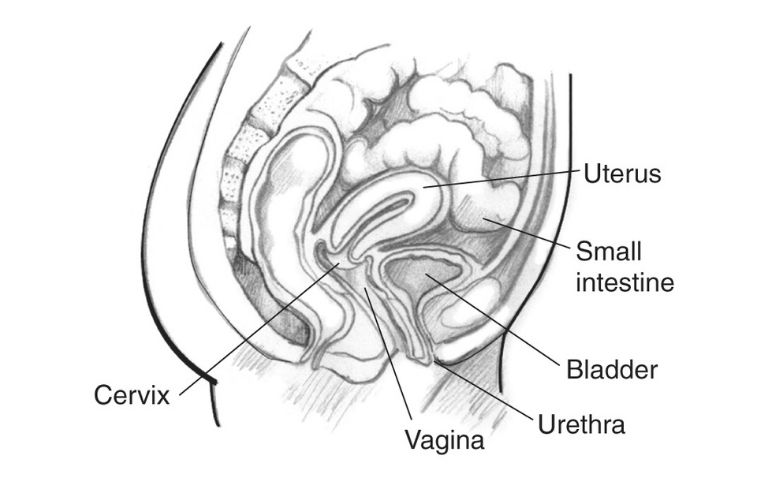 Urethral Stenosis in female