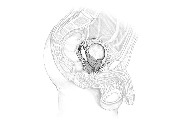 Carcinoma prostate concept