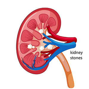 kidney stones