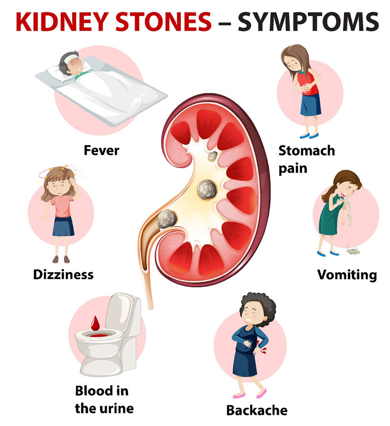 symptoms of kidney stones