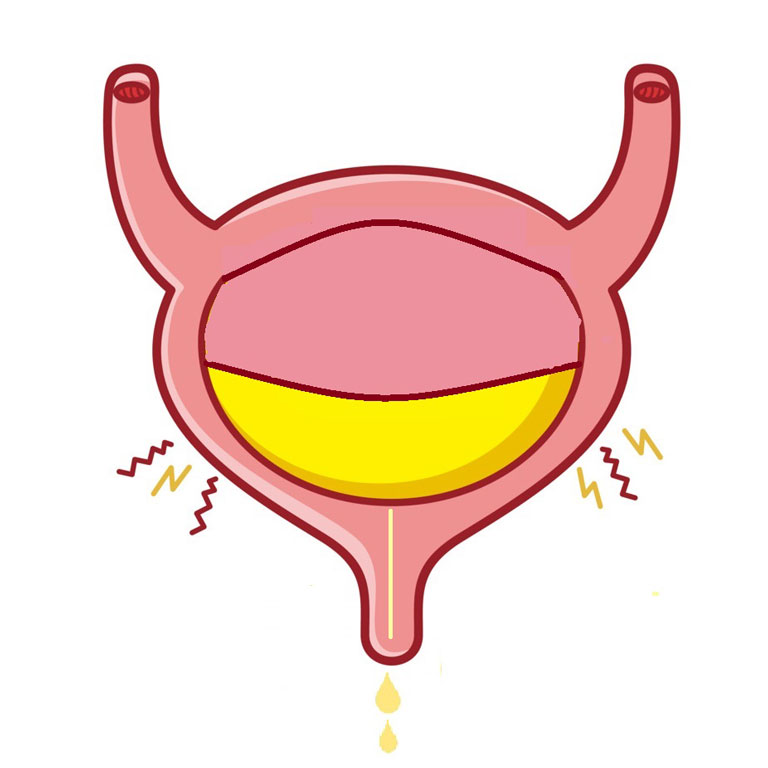 overactive bladder 