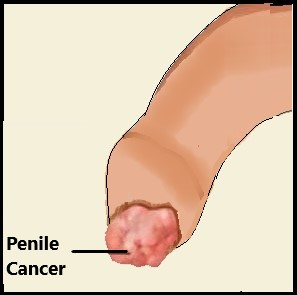 types of Penile cancer 