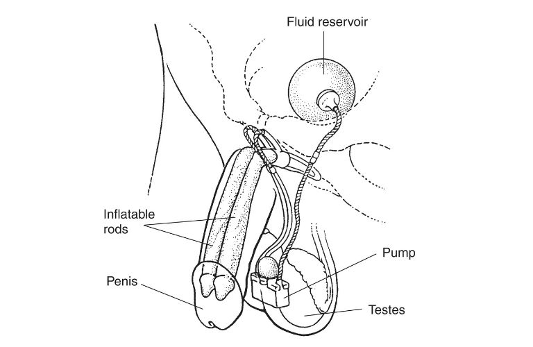 penile-implants