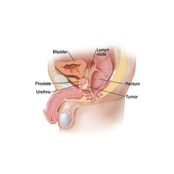 Prostate Cancer
