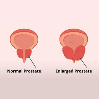 prostate