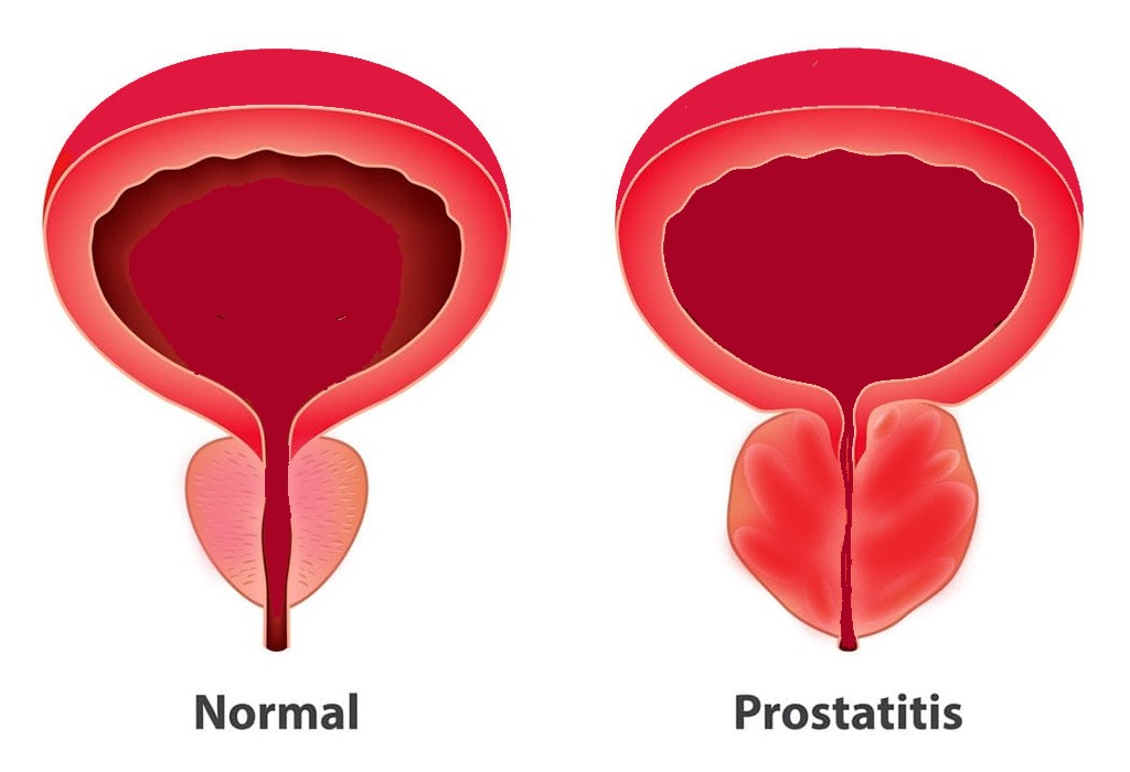 prostatitis