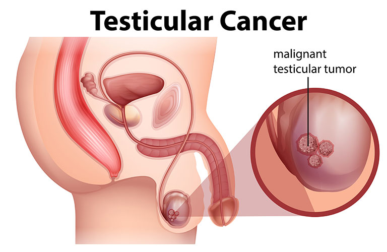 testicular-cancer-01